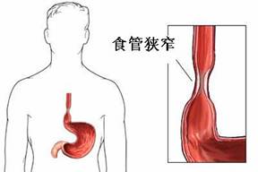 急性腐蝕性食管炎