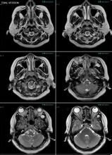顳窩纖維血管瘤