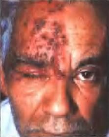 帶狀皰疹病毒性瞼皮炎