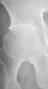 幼年強直性脊柱炎 幼年強直性脊柱炎