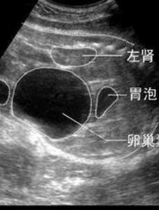腎錯構瘤 腎錯構瘤