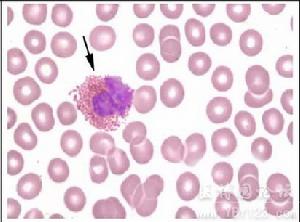 特發性嗜酸性粒細胞增多綜合症