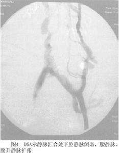 巴德-恰里綜合徵