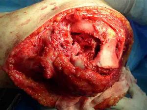 （圖）膝關節結核