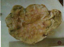 後腎腺瘤 後腎腺瘤