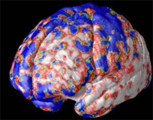 患者大腦灰白質損失圖。藍色部分指示的是沒有發生組織缺損的大腦區域，紅色區域的腦組織發生了10%的缺損，而白色指示的區域腦組織缺損已經達到20%。