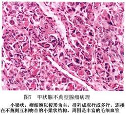 (圖)甲狀腺腺瘤