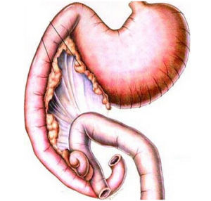 急性胃黏膜病變