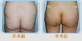 臀部提升術 臀部提升術