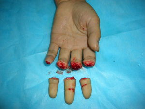 斷指再植 斷指再植