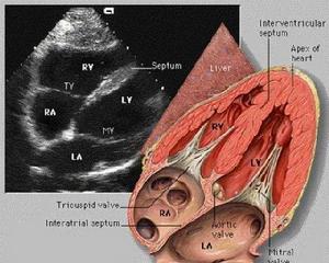 無病狀冠心病 無病狀冠心病