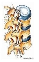 椎間盤突出症 椎間盤突出症