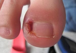 初期甲溝炎 初期甲溝炎