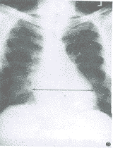 （圖）X線檢查示心臟擴大