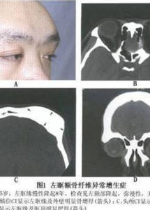顱骨纖維異常增生症 顱骨纖維異常增生症