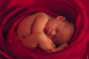 先天性高胰島素血症