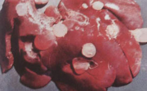 肝臟上得“細頸囊尾蚴”