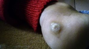 深部真菌 深部真菌