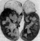 腎上腺結核病 腎上腺結核病