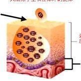 尖銳濕疣病毒 尖銳濕疣病毒