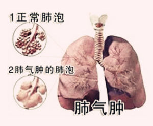 慢性阻塞性肺氣腫 慢性阻塞性肺氣腫