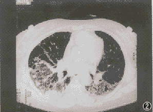 非特異性間質性肺炎