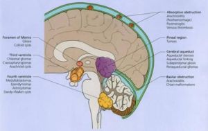 流行性腦脊髓膜炎