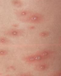 斑丘疹 斑丘疹