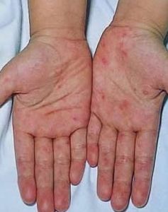 性病性淋巴肉芽腫 性病性淋巴肉芽腫