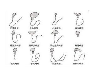 畸形精子 畸形精子