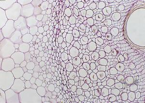原發性甲狀旁腺功能亢進症與腎病