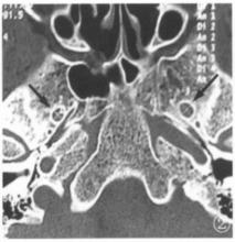 圖1 卵圓孔為圓形、兩側對稱