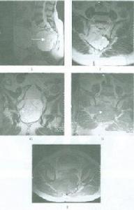 寰樞椎旋轉脫位
