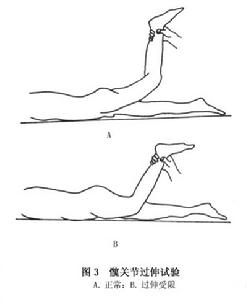 （圖）髖關節結核病