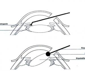 白內障囊內摘除術