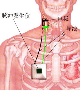 特發性癲癇綜合徵