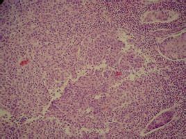 神經內分泌癌 神經內分泌癌