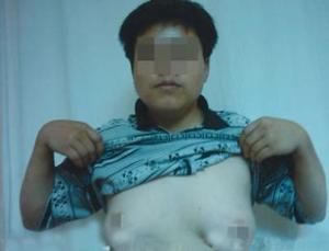 男性青春期乳房發育 男性青春期乳房發育