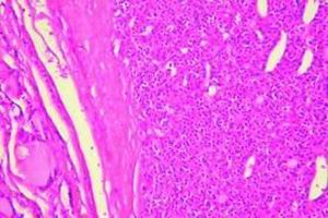 甲狀旁腺功能減退症